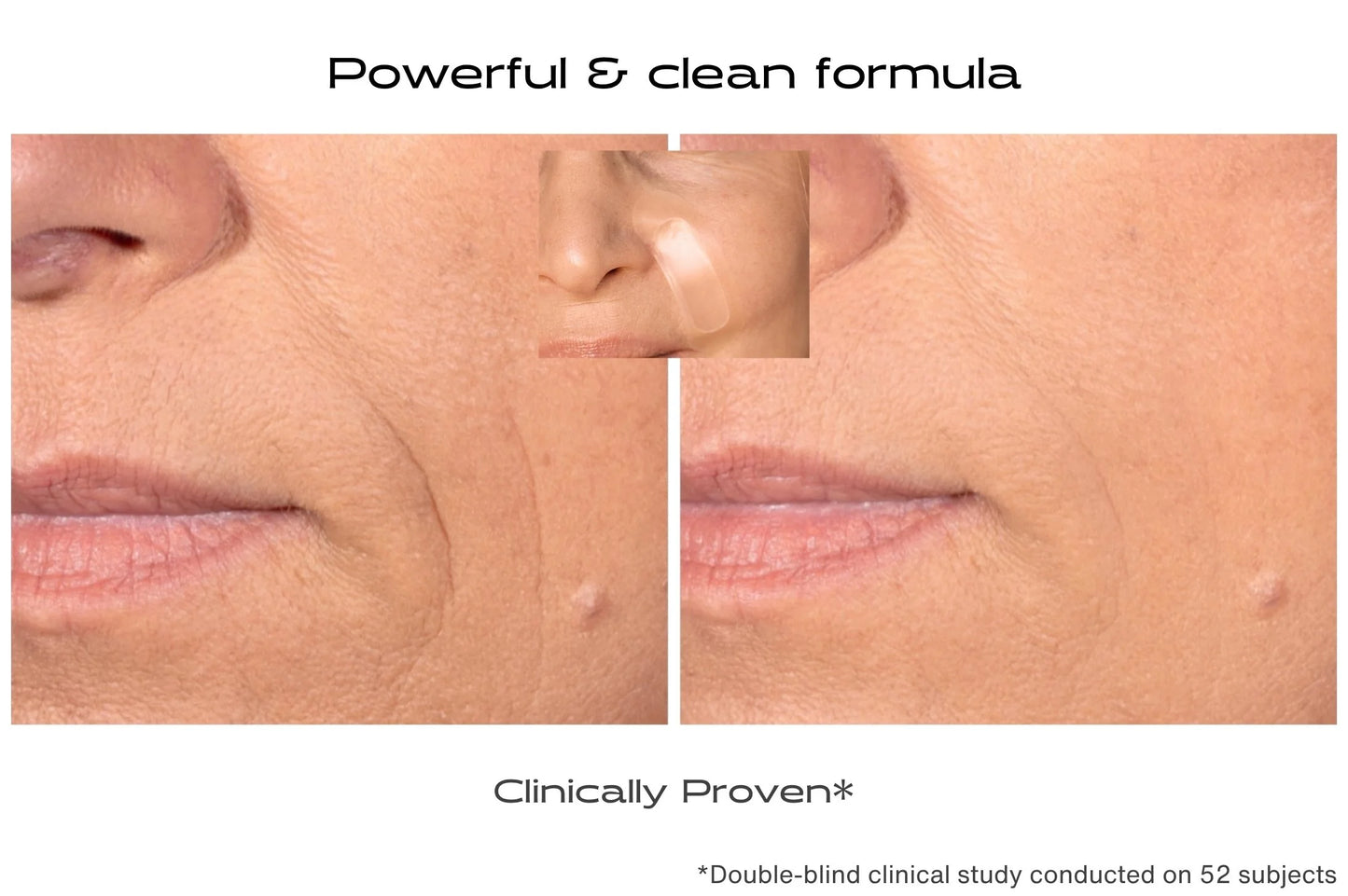 Before and after comparison of skin treatment on a person's face with text indicating a powerful and clean formula.