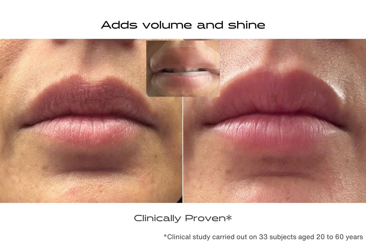 Before and after lip patch to add volume