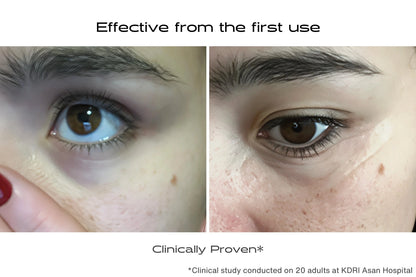 Before and after using eye contour patches with 900 micro-cones for dark circles