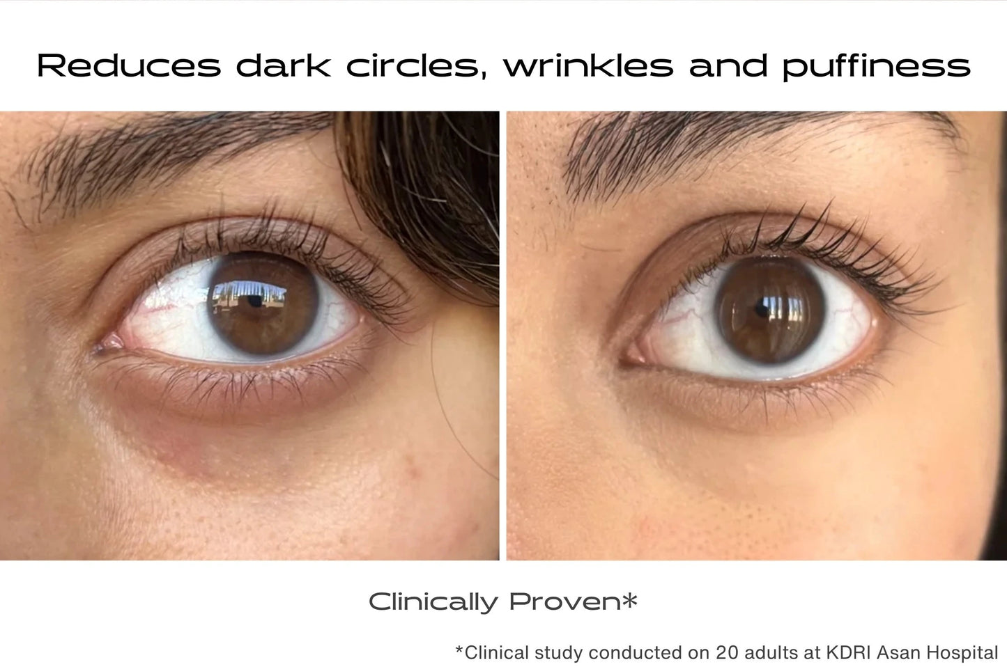 Before and after using microneedle eye contour patches for dark circles