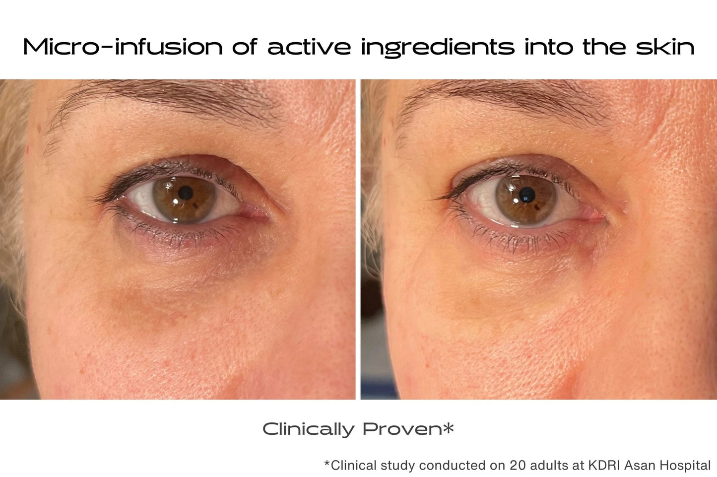 Before and after using microneedle eye patches to treat dark circles, wrinkles, and puffiness