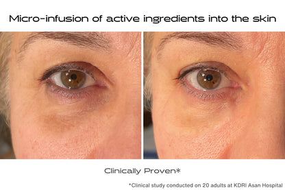 Before and after using microneedle eye patches to treat dark circles, wrinkles, and puffiness
